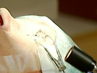 VIDEO: Artificial corneas may be the answer in the fight against blindness.