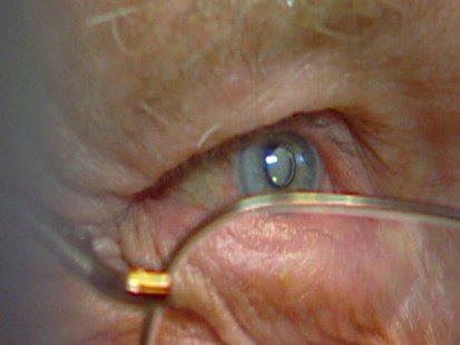 VIDEO: Linsey Davis on the procedure to implant a tiny telescope in the eye.