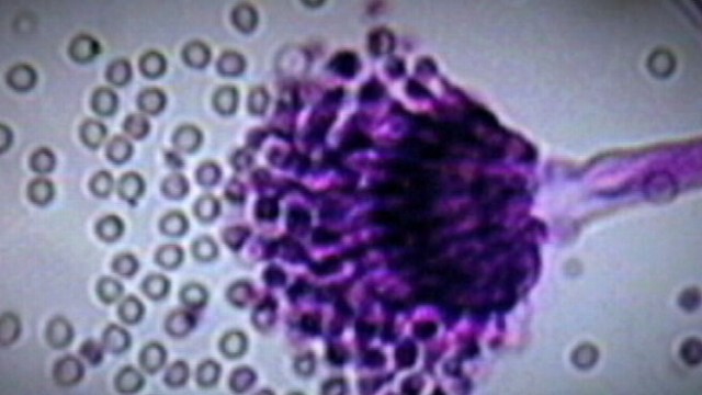 Year In Review Meningitis Outbreak Still A Challenge Abc News